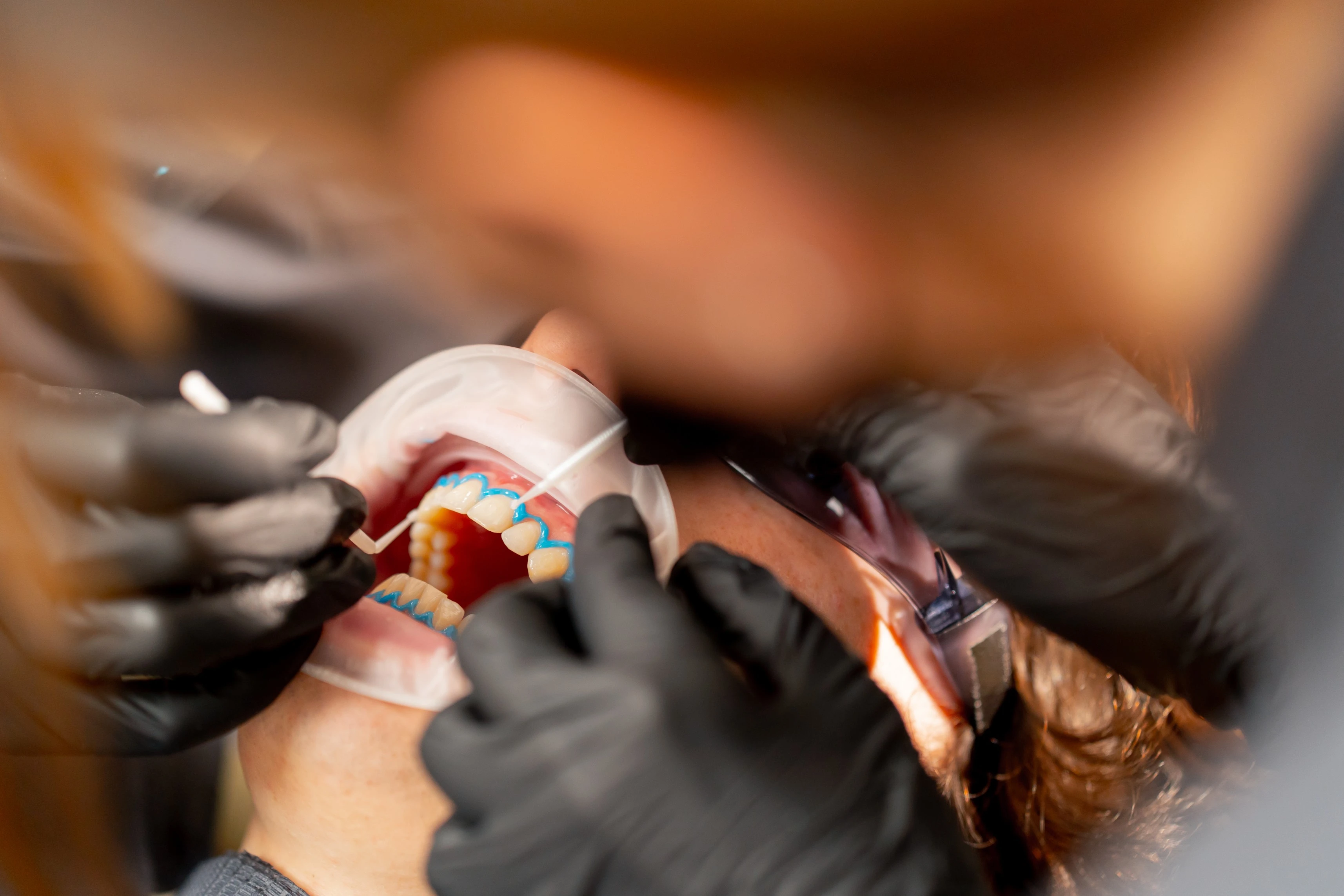 Composite Bonding